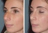 Female Patient, Primary Rhinoplasty