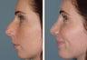 Female Patient, Primary Rhinoplasty