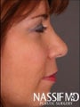 Female Revision Rhinoplasty