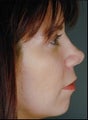 Female Revision Rhinoplasty