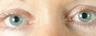 Eyelid Surgery