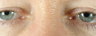 Eyelid Surgery