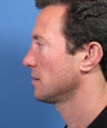 Revision Rhinoplasty for Tip Ptosis Excessively Long Nose