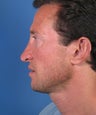 Revision Rhinoplasty for Tip Ptosis Excessively Long Nose