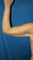 liposuction of arms