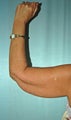 liposuction of arms