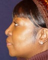Rhinoplasty Side View
