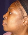 Rhinoplasty Side View