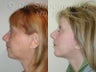 Sluplift, Forehead Lift, Upper and Lower Blepharoplasty & Obagi Blue Peel
