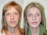 Sluplift, Forehead Lift, Upper and Lower Blepharoplasty & Obagi Blue Peel