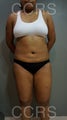 28 yr. old with generalised fat deposition (VASER)