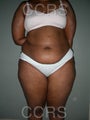 28 yr. old with generalised fat deposition (VASER)