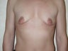 Bilateral submuscular augmentation with 300 cc saline implants inflated to 300 cc and bilateral periareolar mastopexies