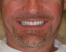 32 year old male treated with All-on-4 Dental Implant Procedure