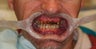 32 year old male treated with All-on-4 Dental Implant Procedure