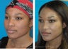 30 year old African American Rhinoplasty Madison WI