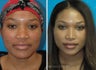 30 year old African American Rhinoplasty Madison WI