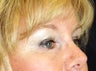 Browlift, upper blepharoplasty