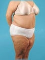 Weight Loss (Massive) & Tummy Tuck