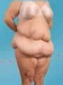 Weight Loss (Massive) & Tummy Tuck