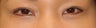 Bilateral Asian Eyelid Surgery