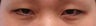 Bilateral Asian Eyelid Surgery