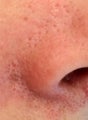 Laser Vein Removal