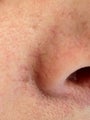 Laser Vein Removal