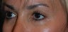 young lady who does not appreciate the puffy/hollow look that has developed under her lower lids.