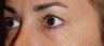 young lady who does not appreciate the puffy/hollow look that has developed under her lower lids.