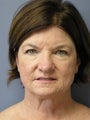 LiteLift™, Blepharoplasty, Temple Brow Lift on 62-year-old Woman