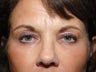 Upper and Lower Eyelid Lift