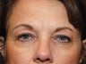 Upper and Lower Eyelid Lift