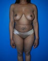 Liposuction and Mini-Tummy Tuck