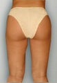 Liposuction