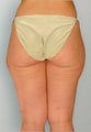 Liposuction