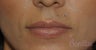 37 y/o female desired permanent lip augmentation.