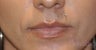 37 y/o female desired permanent lip augmentation.