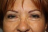 Blepharoplasty