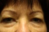 Blepharoplasty