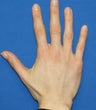 Hand Rejuvenation with Filler