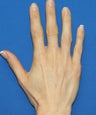 Hand Rejuvenation with Filler
