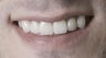 Restoration with Porcelain Crowns