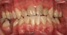Restoration with Porcelain Crowns