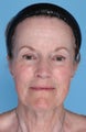 Earlobe Reduction
