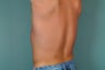 Smart Lipo