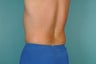 Smart Lipo