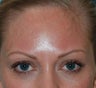 Fraxel Re:Pair treatment of Melasma