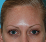 Fraxel Re:Pair treatment of Melasma