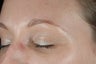 Botox